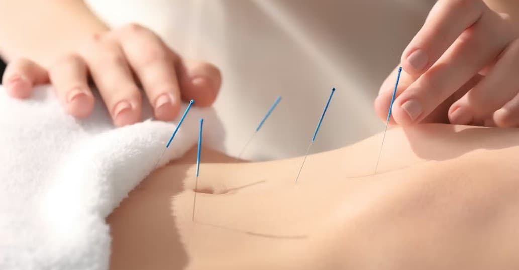 Image representing acupuncture for infertility.